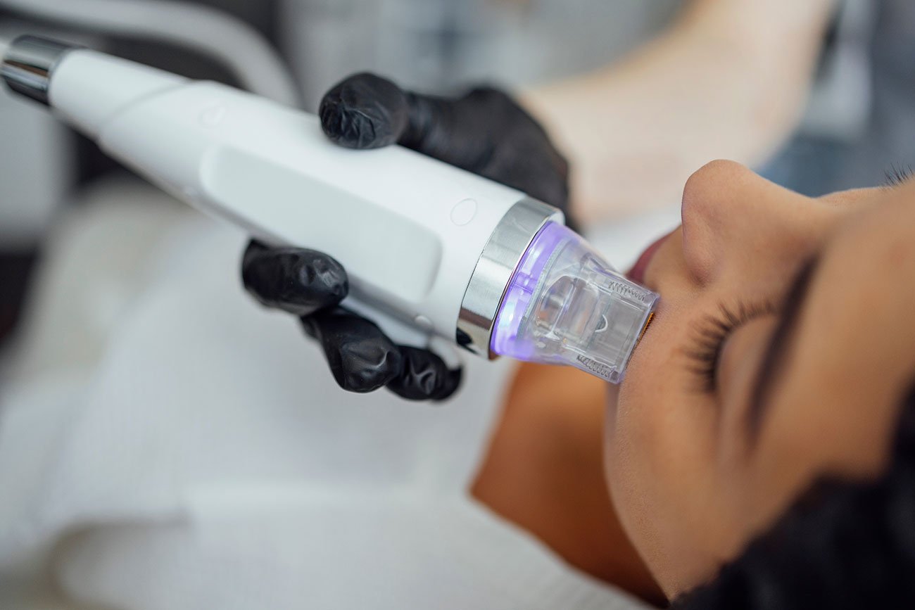 Fractora RF Microneedling
