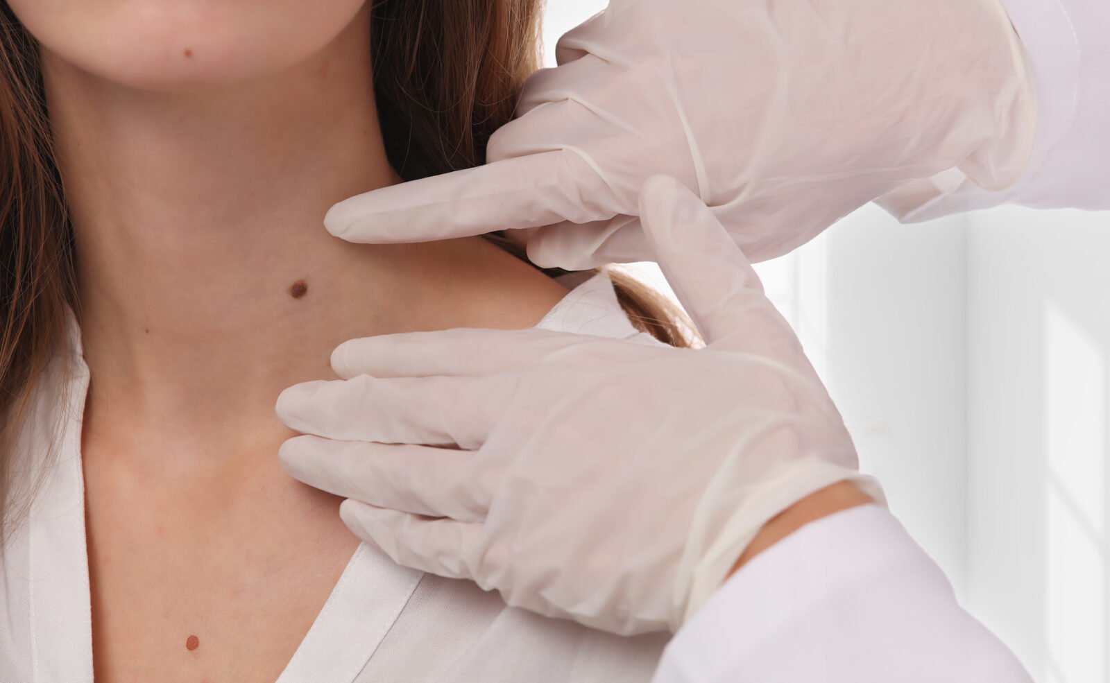 Close-up of skin tag removal procedure on neck