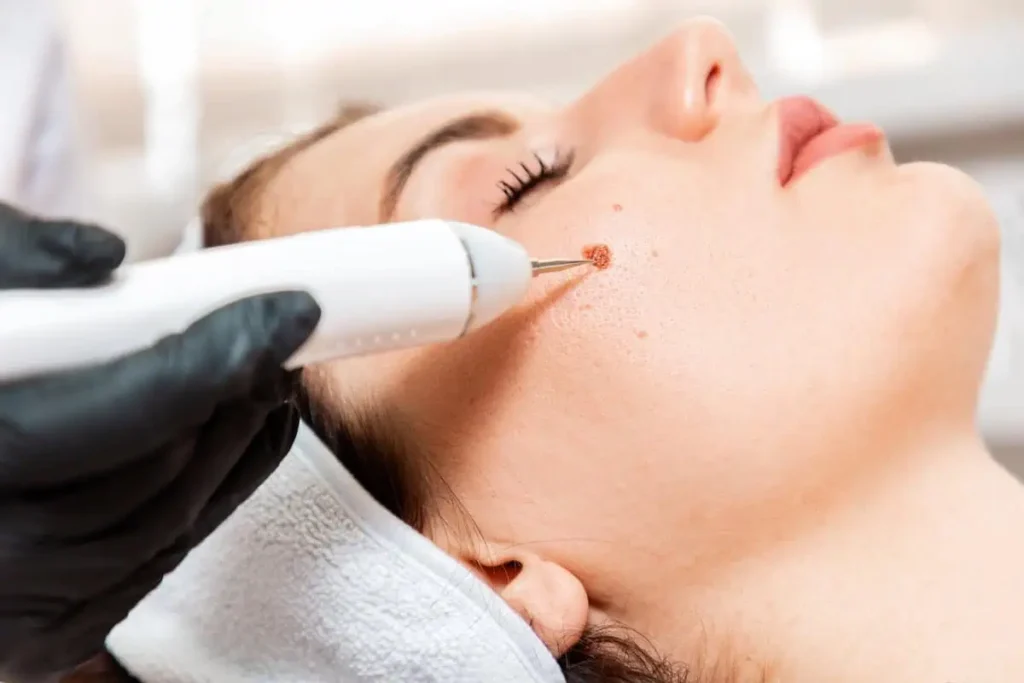 Professional mole removal procedure